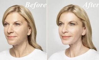 Before and after using Goji Cream