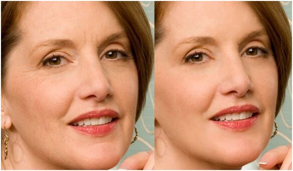 before and after plasma skin rejuvenation