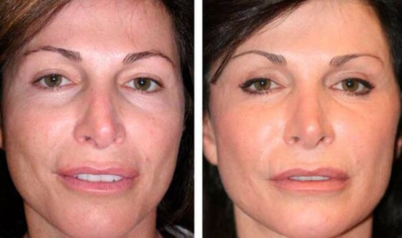 photo before facial skin rejuvenation after plasma