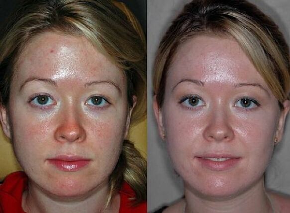 photographs before and after the plasma rejuvenation procedure