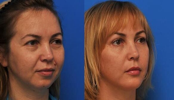 before and after skin rejuvenation with tightening photos 1