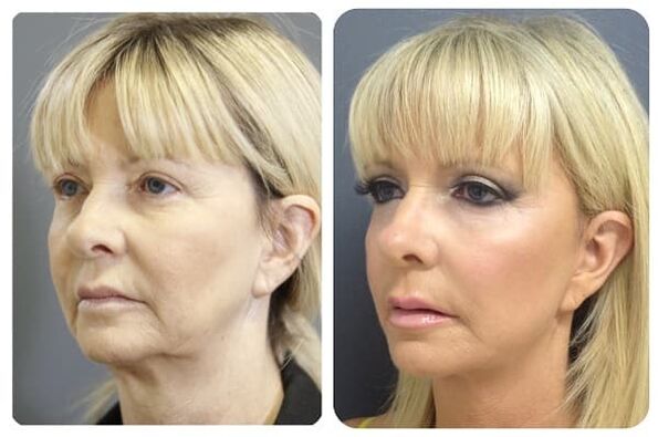before and after skin rejuvenation with tightening photos 2