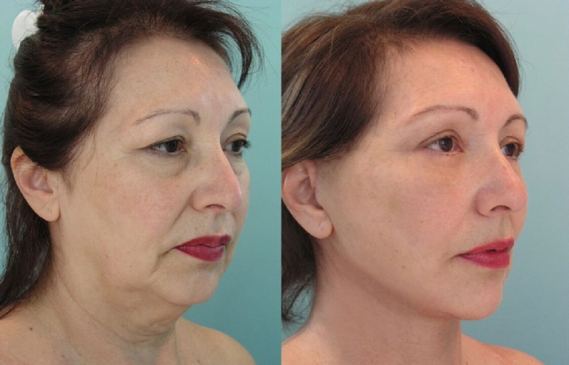 Before and after the facelift thread