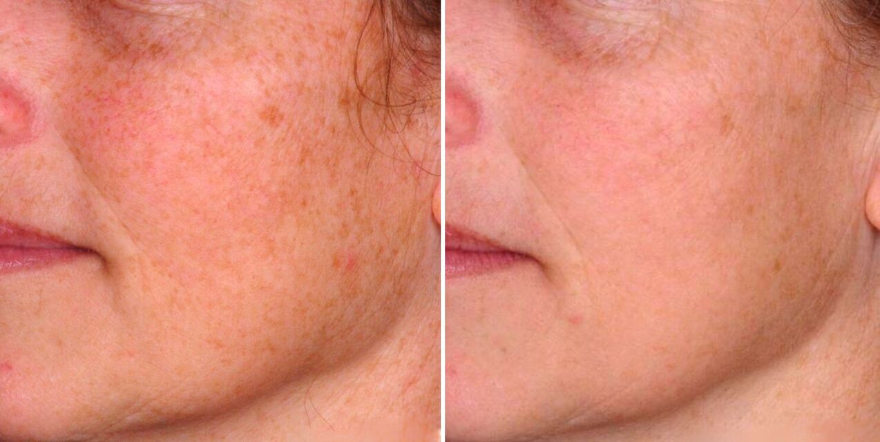 The result of fractional photothermolysis is the reduction of age spots on facial skin. 