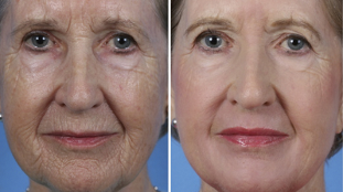 fractional facial rejuvenation before and after photographs
