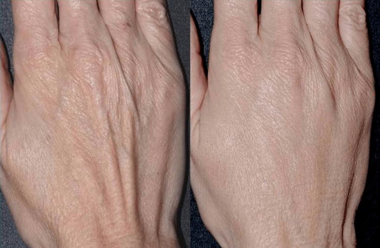 contour plastic, hand rejuvenation photos 2 before and after