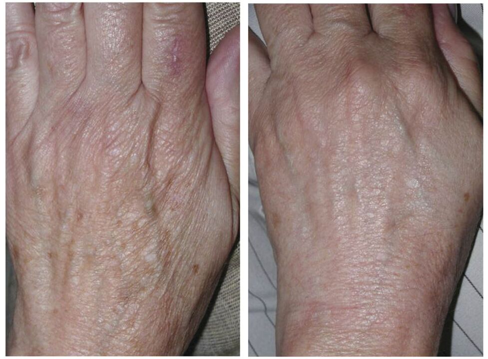 laser hand rejuvenation before and after photos